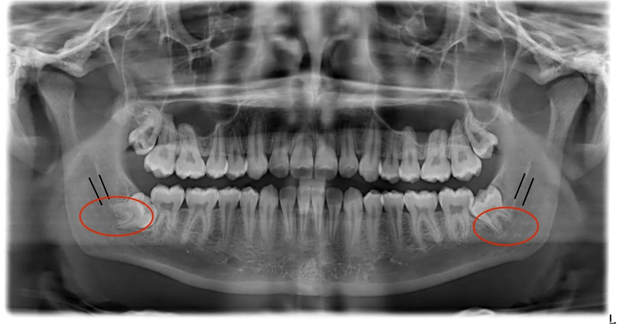 wisdom tooth removal Littleton