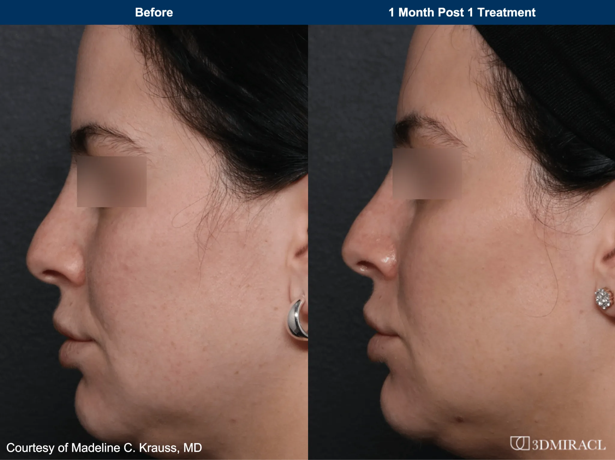 UltraClear before and after photos