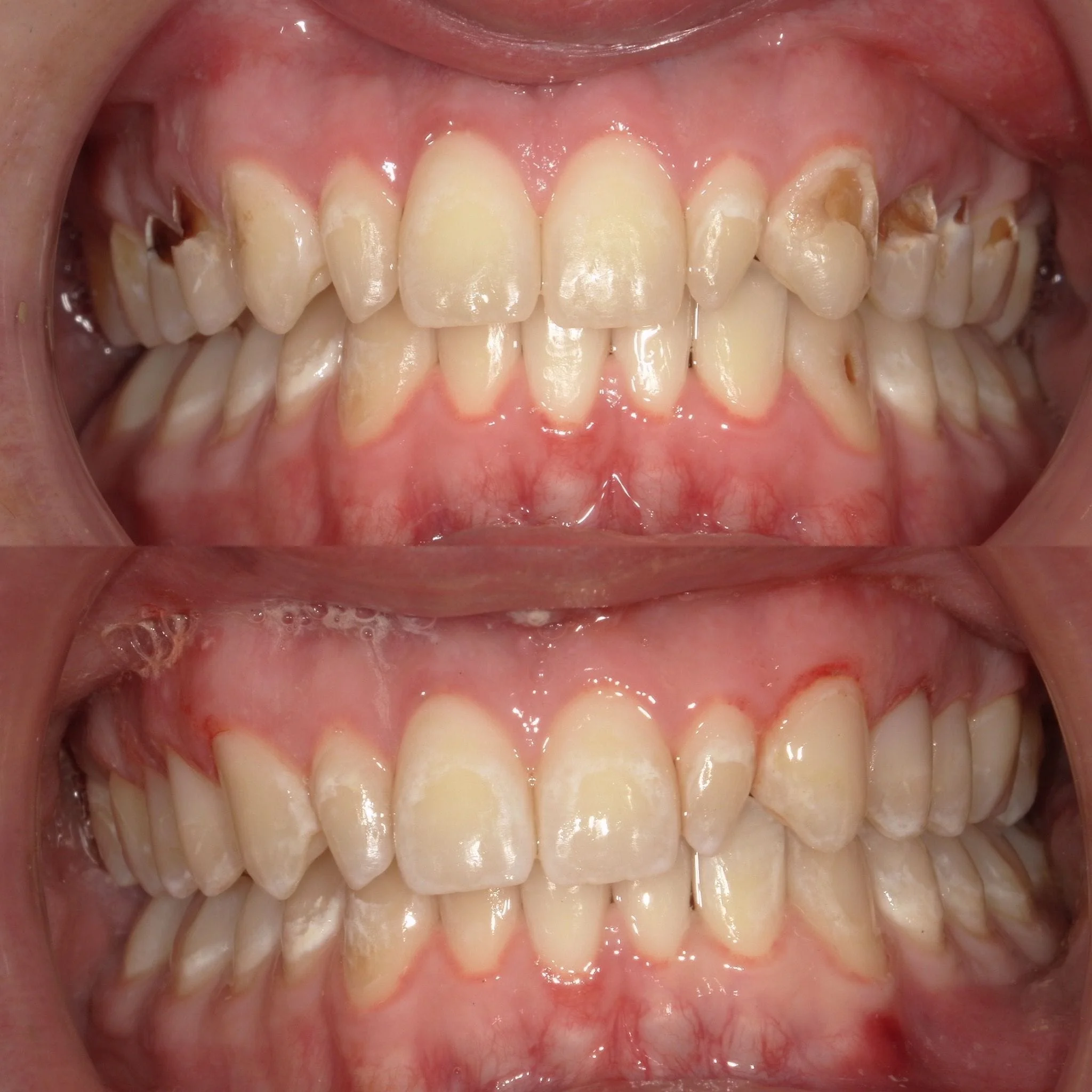 Decay removal, new smile