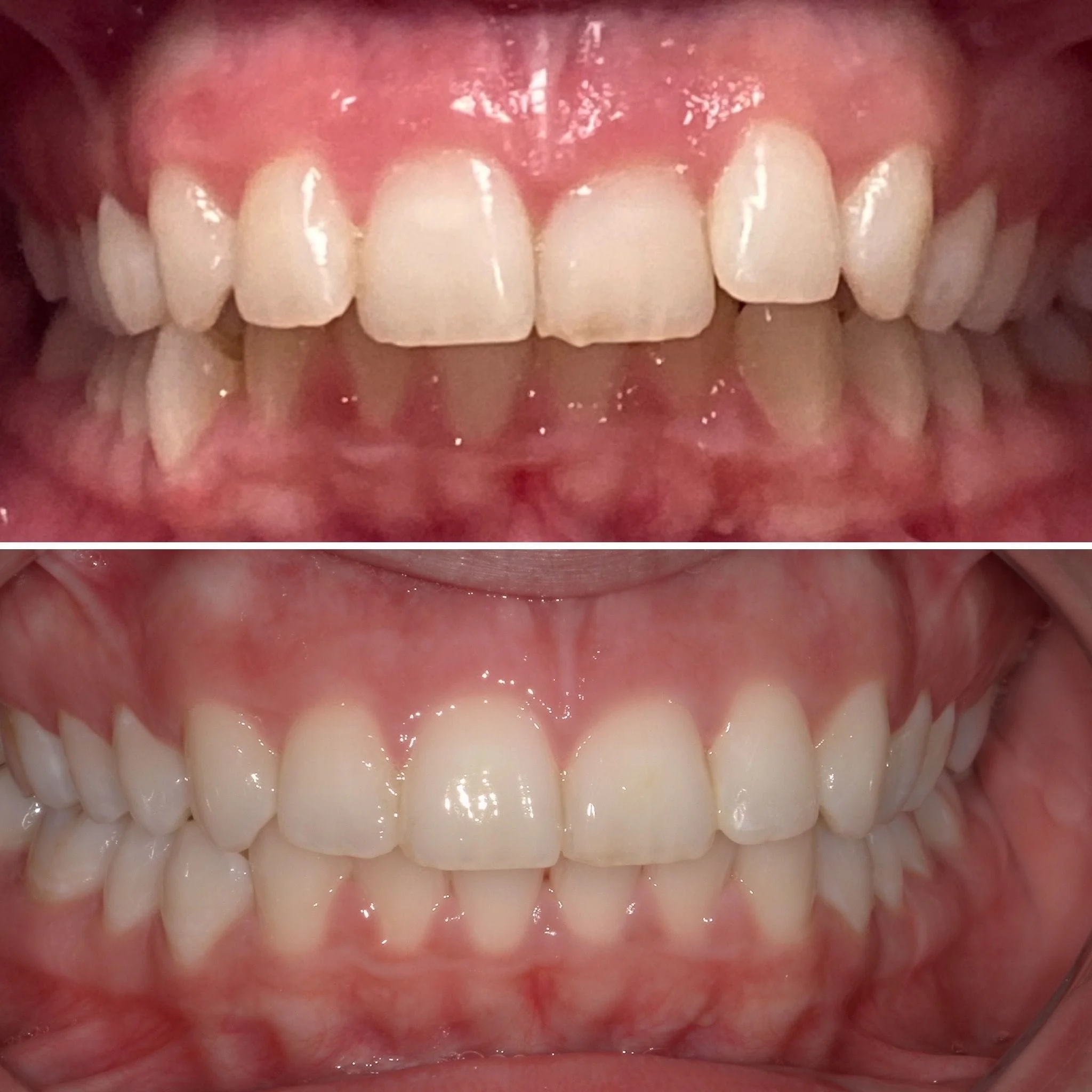 Invisalign, clear aligners