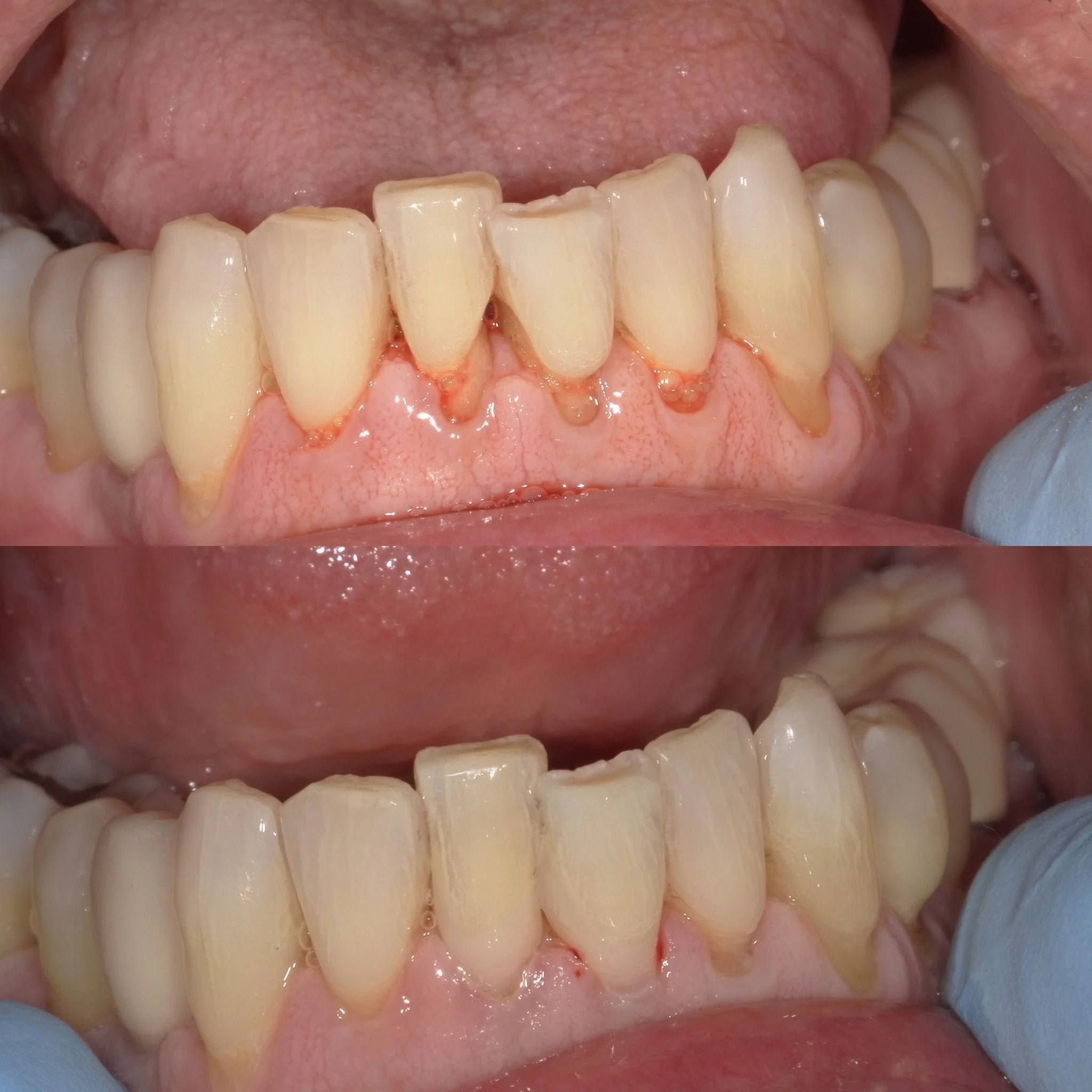 Cosmetic fillings to make teeth look young