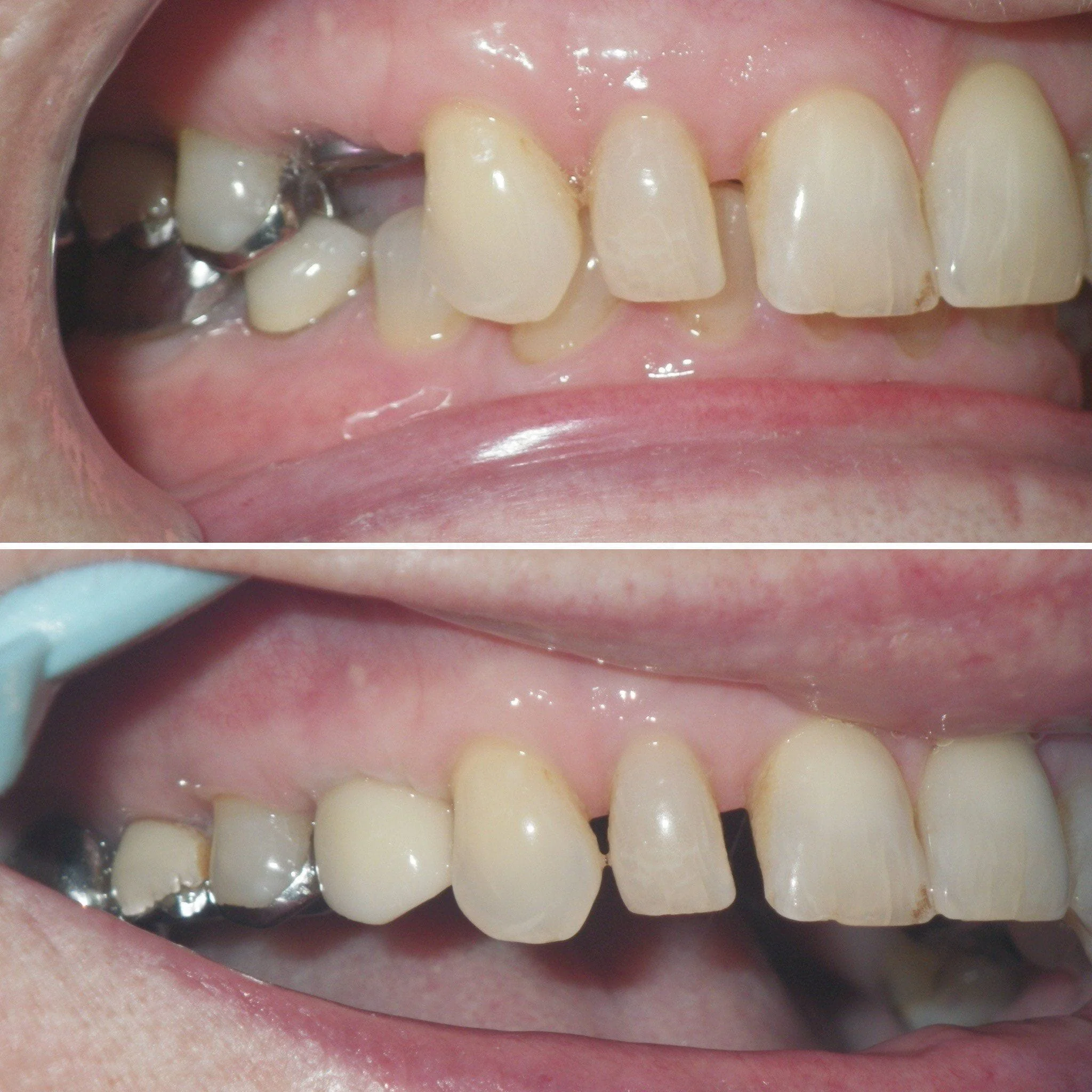 Brookline Dentist, Dental Implants 