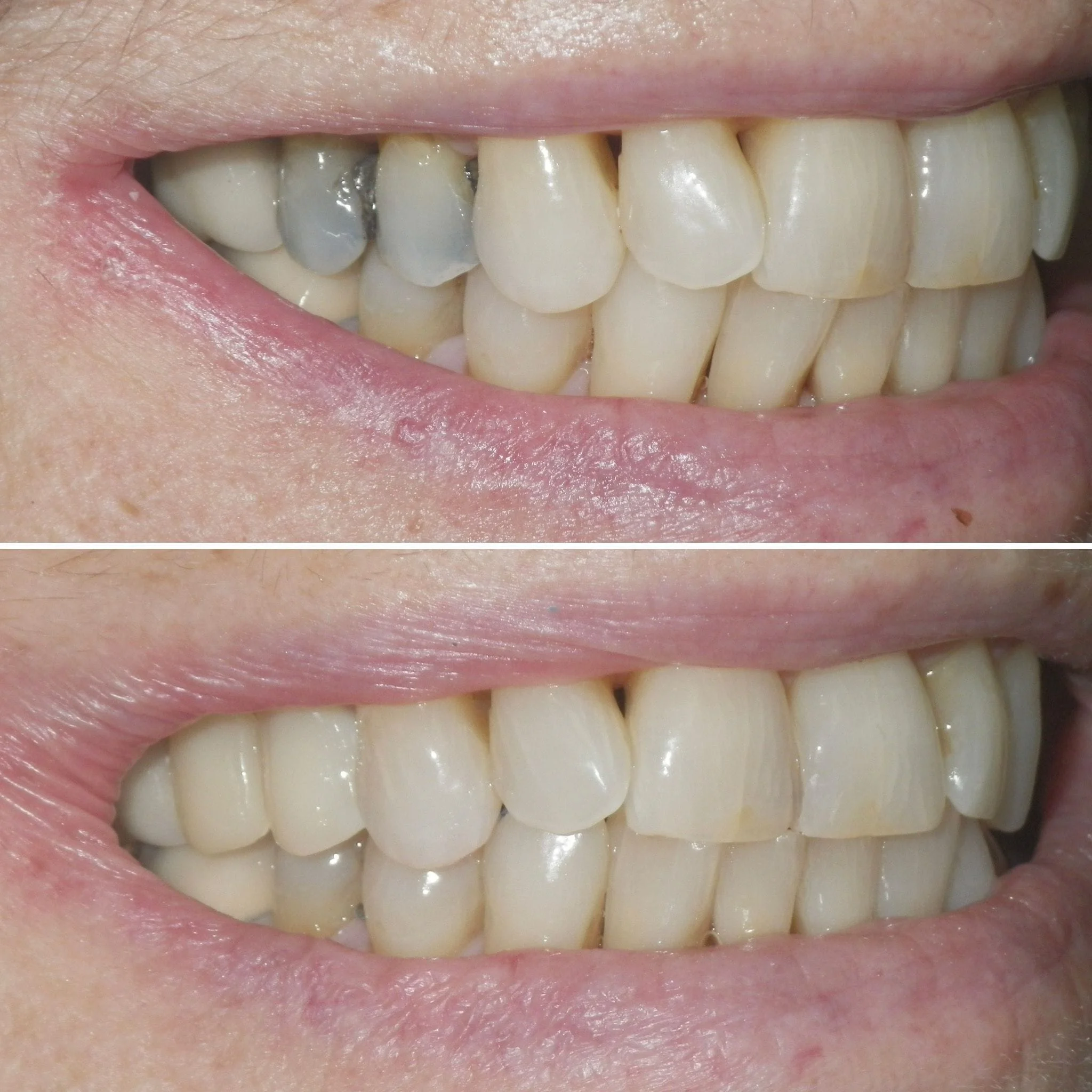 Cosmetic Dentist Crowns 
