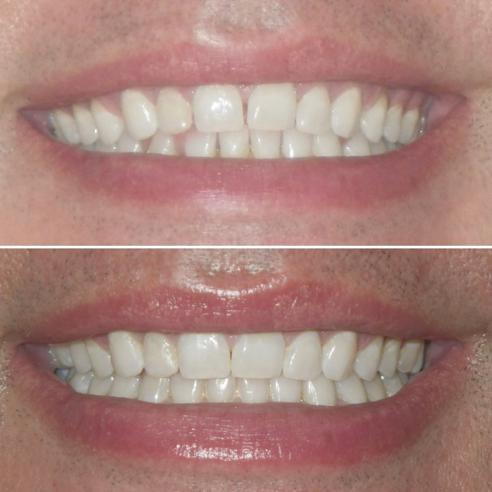 Invisalign before and after brookline MA