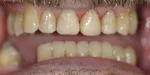man's teeth close up looking a little whiter and better shaped after cosmetic fillings Cumberland Park SA cosmetic dentist