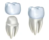 illustration of tooth and roots with tooth prepared to received crown, dental crowns Harrisburg, PA dentist