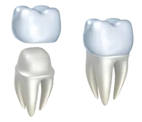 illustration of crown being fitted over tooth, dental crowns Somerville, MA
