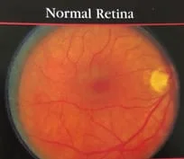 Normal retina