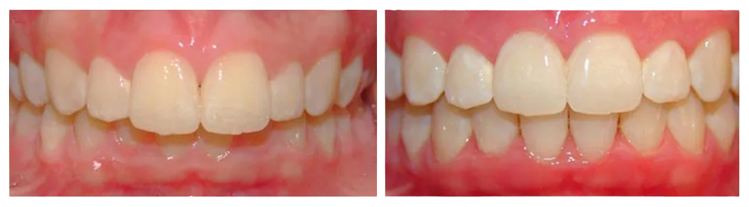 before and after of overbite correction with Invisalign treatment Westminster, MD