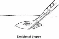 Biopsy3