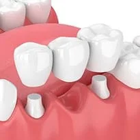 illustration of bridge being attached in mouth, dental bridge Seminole, FL family dentist