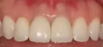 Pittsburgh Pittsburgh periodontist picture after crown lengthening