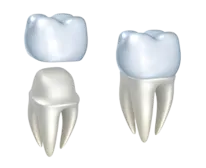 illustration of dental crown fitting over tooth, dental crowns Salem, OR dentist