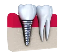 dental implant embedded next to natural tooth, implant dentist Dayton, OH