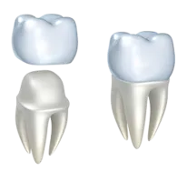illustration of crown fitting over tooth, dental crowns Decatur, IL dentist
