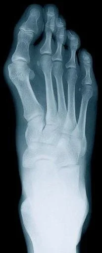 Solon Podiatrist | Solon Rheumatoid Arthritis | OH | Ohio Foot and Ankle Clinics |
