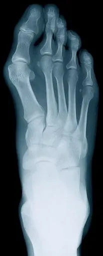 Rheumatoid_arthritis1.jpg