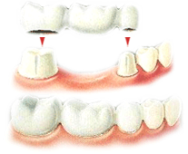 illustration of dental crowns and dental bridge replacing tooth Mahwah, NJ