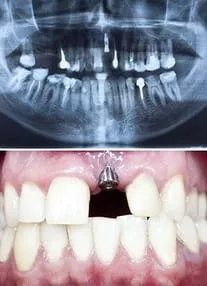 Dental Implants In Parker, CO