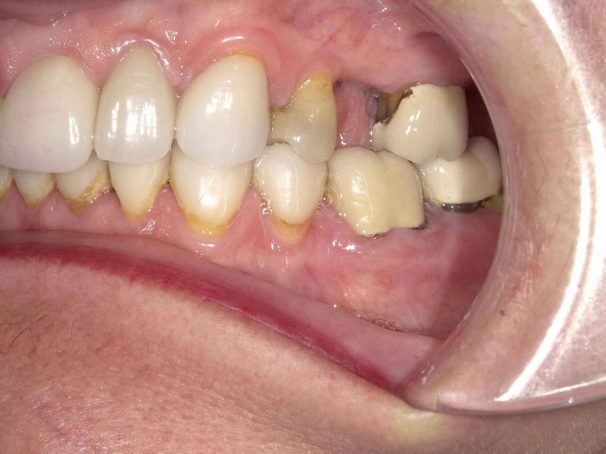 Before And After Dental Implants North York ON