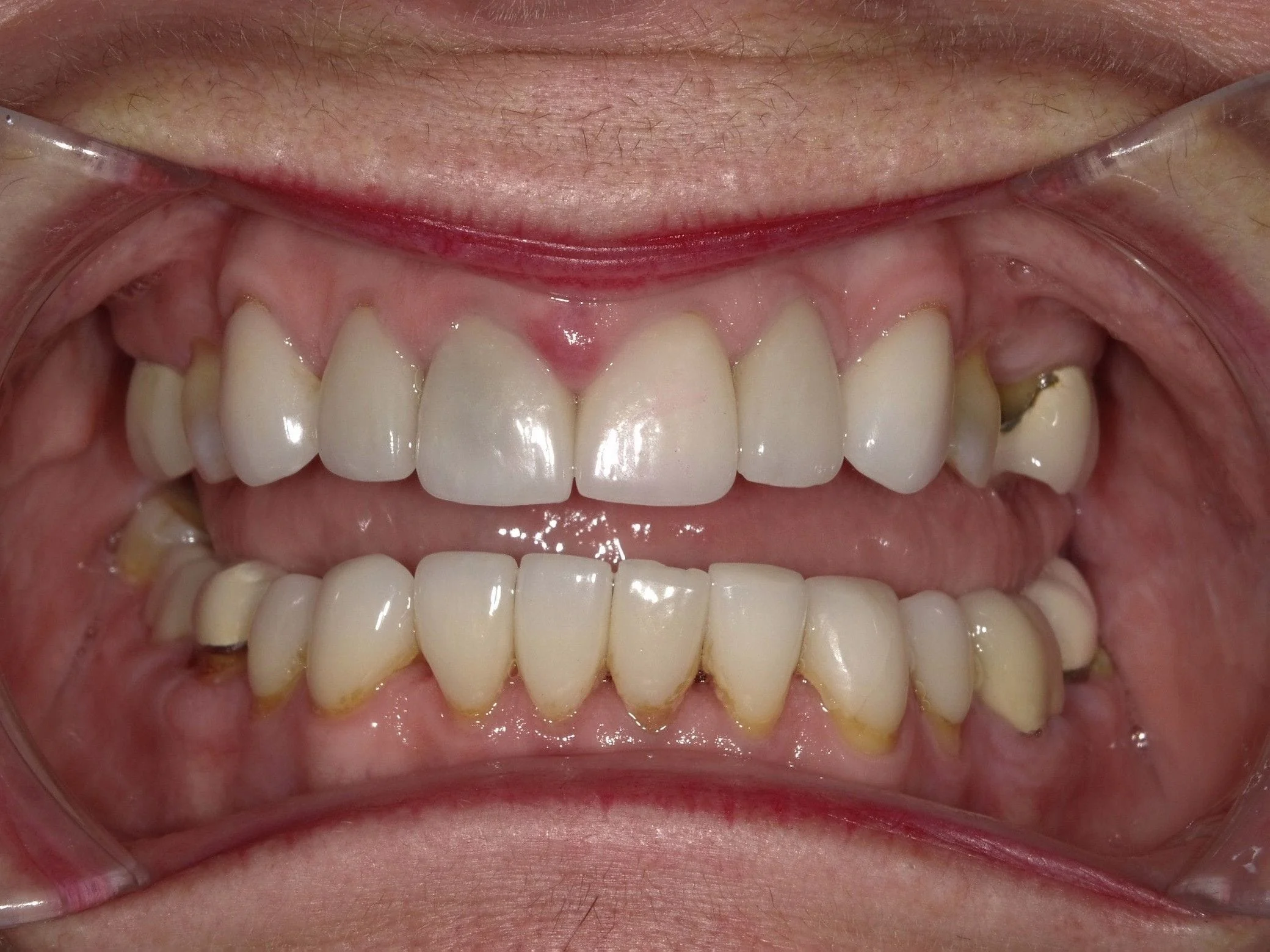 Before And After Dental Implants North York ON