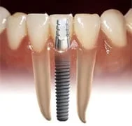 Plantation_Dental_Implants.jpg