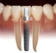 Dental Implants Plantation, Orthodontic Implants