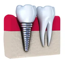 dental implant in Shrewsbury, NJ