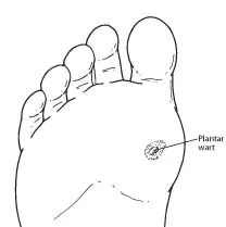 Plantar Wart in Boca Raton, FL 