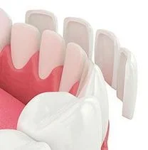 3D illustration of lower teeth and gums with dental veneers being placed over teeth, veneers Hayward, CA cosmetic dentist