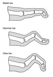 Blackmer Foot & Ankle  Hallux Rigidus Big Toe Joint Arthritis) in Meridian