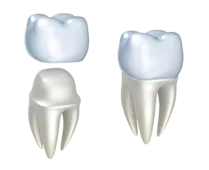 illustration of crown covering tooth, dental crowns San Diego, CA