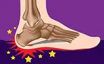 Need the Best Plantar Fasciitis Treatment in Richmond VA?