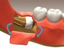 Oral Surgery Nepean