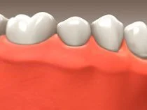 Dental Implant in Nepean