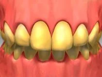 Teeth Whitening in Nepean