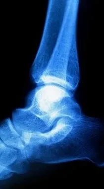 Latham Podiatrist | Latham Haglund's Deformity | NY | Capital Foot Specialists |