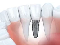 illustration of implant in jaw with natural teeth, cosmetic and implant dentistry Salem, OR dental implants