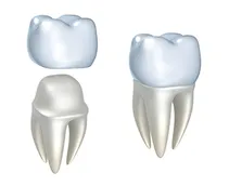 illustration of dental crown assembly, CEREC single visit dental crowns Portland, OR