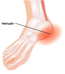 Heel pain picture