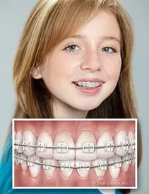 blond girl wearing ceramic clear braces, box within image showing close up of teeth with clear braces Fairfax, VA orthodontist