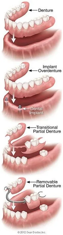 types of dentures Amelia, OH