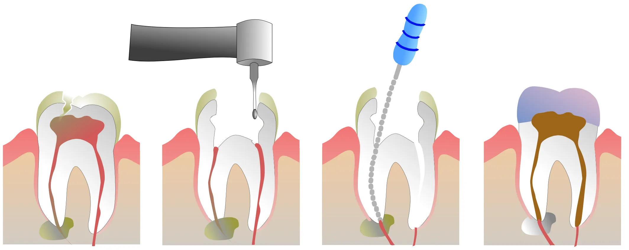 Root Canal