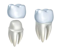illustration of crown being placed over prepared tooth, dental crowns Huntsville, AL