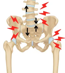 SI - Buttock Pain Relief, stretches, exercises and nutritional advise