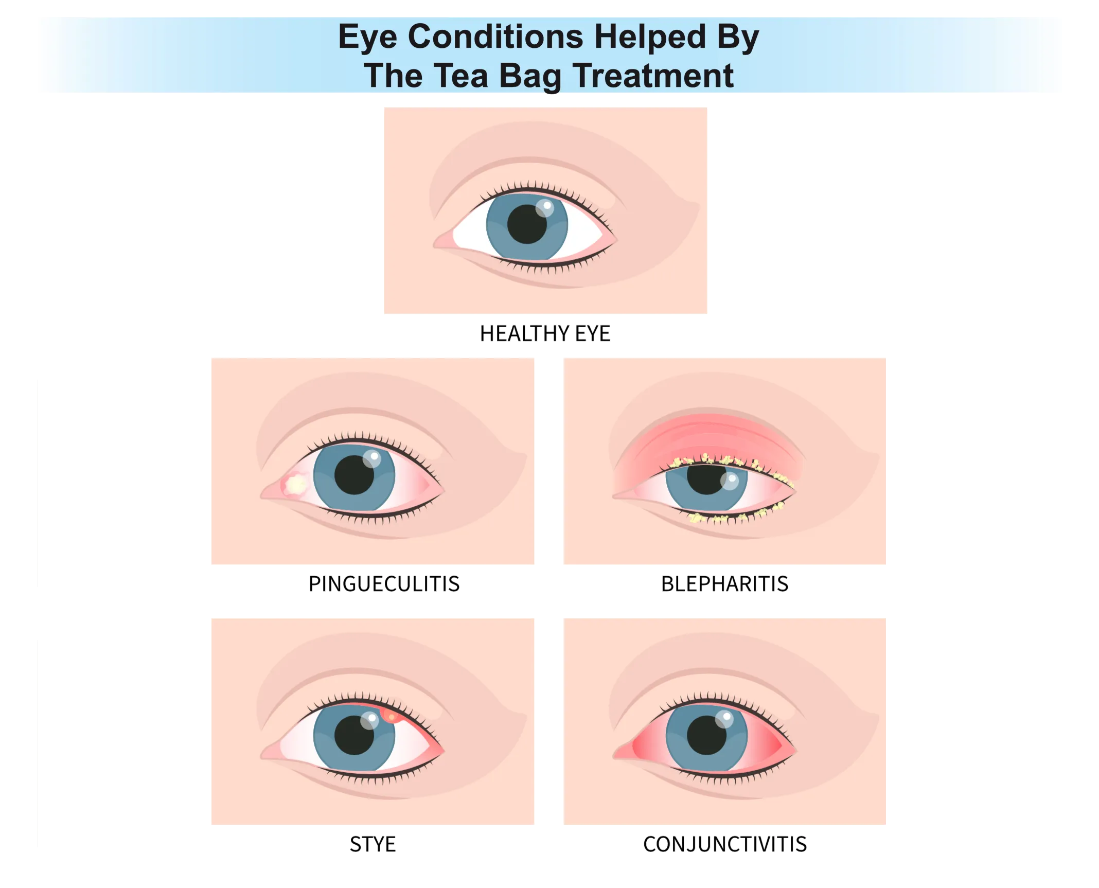 Home Remedies That Can Help Eye Conditions
