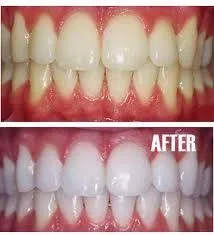 Teeth Whitening | Dentist in Roselle, IL | Roselle Dental Associates