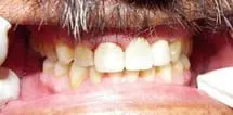 after dental implants