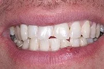 Before Bonding Repair of Teeth Fracture