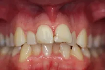 Before Invisalign Plus Cosmetic Bonding 